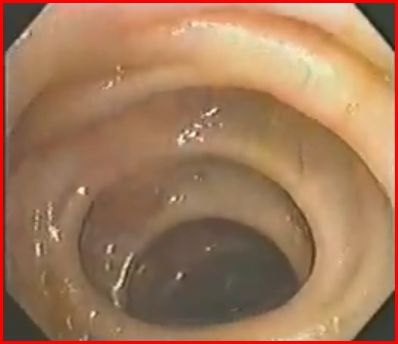 Immagine endoscopica del colon