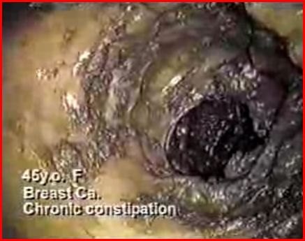Immagine endoscopica del colon