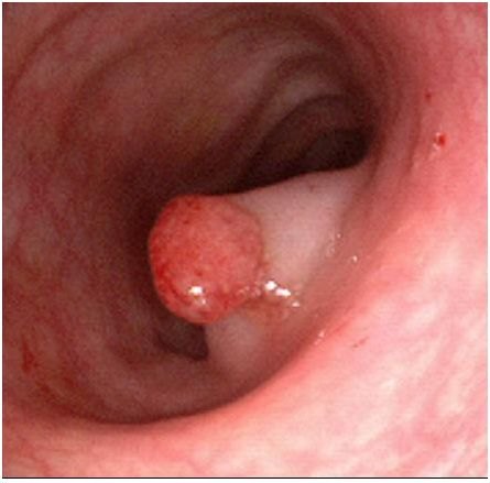 Immagine endoscopica del colon
