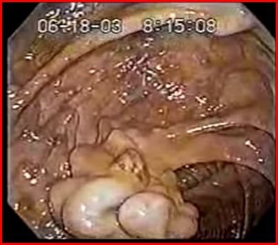 Immagine endoscopica del colon