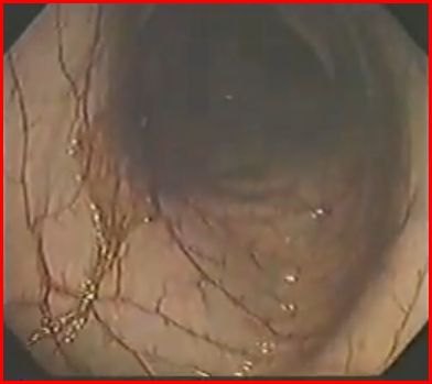 Immagine endoscopica del colon