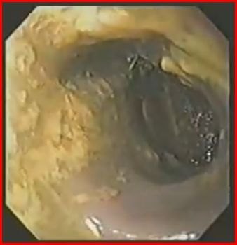 Immagine endoscopica del colon